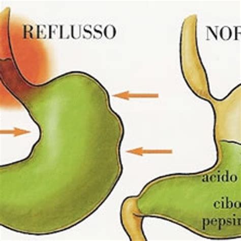 Chirurgia Bariatrica E Reflusso La Sleeve Modificata Aiuta Rubriche