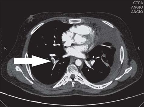 Computed Tomography Pulmonary Angiography Ctpa Showing Right Lower