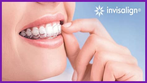 Niềng Răng Trong Suốt Invisalign Và Những Điều Bạn Nên Biết