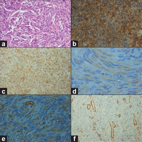 A Microphotograph Of The Tumor Showing Interlacing Bundles Of Spindle