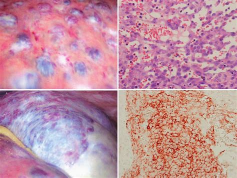 Angiosarcoma Of The Spleen And Liver The Left Panels Represent A