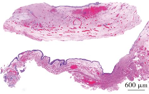 Ranula Histology