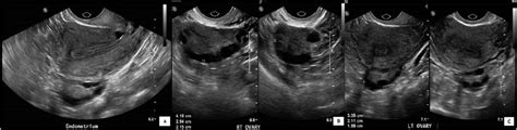 Transvaginal Ultrasound Pelvis Images A Sagittal View Of The Uterus