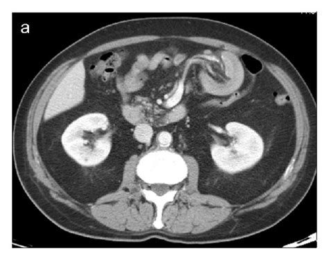 Enteroenteric Ileoileal Intussusception Caused By Lymphoma Axial CT