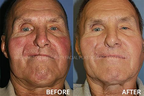 Before And After Facial Plastic Surgery Center Washington