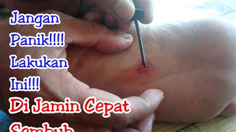 Di Jamin Cepat Sembuh Cara Mengatasi Paku Yang Tertusuk Di Kaki