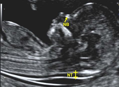 Nuchal Translucency Scan Nt Mnsonography