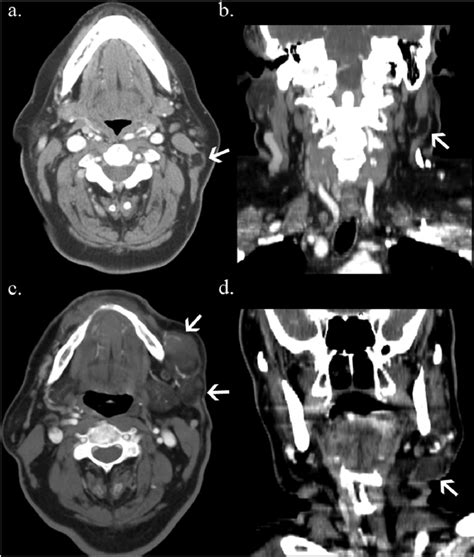 Recurrent Liposarcoma A Axial Post Contrast Ct And B Coronal