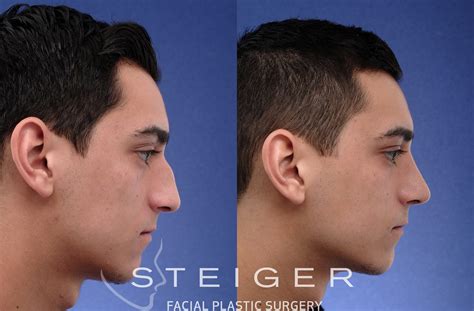 Rhinoplasty Before And After Photos