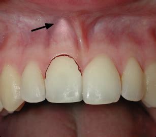 Lateral Luxation | Pocket Dentistry