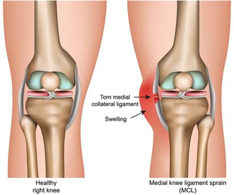 The Medial Collateral Ligament MCL Dr Mohamed Attia M D PhD