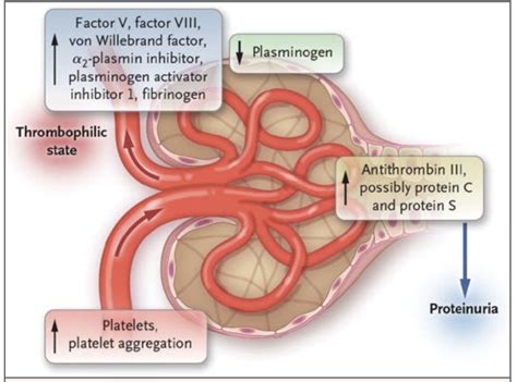 To Send Home Or Not Ac In Nephrotic Syndrome Sinai Em