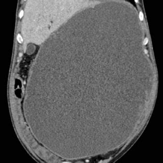 Cect Coronal Image Showing The Large Cystic Lesion With Complete Loss