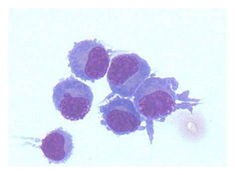 Plasmacytoid Cells Found On Cytospin Of The Cerebrospinal Fluid