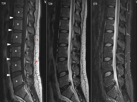 Figure 1 From Serous Atrophy Of Bone Marrow A Rare Disorder Worth