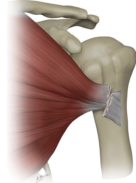 Us And Mr Imaging Of Pectoralis Major Injuries Radiographics