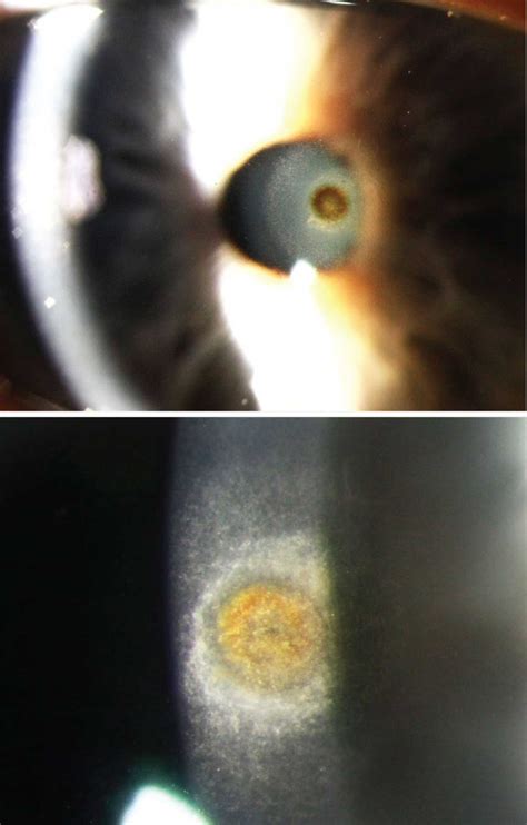 Corneal Rust Ring