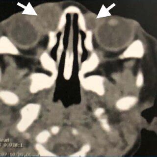 Axial Computed Tomography Scan Shows Bilateral Masses At The Medial