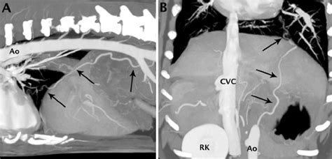 A Sagittal Thin Slab Maximum Intensity Projection Mip And B