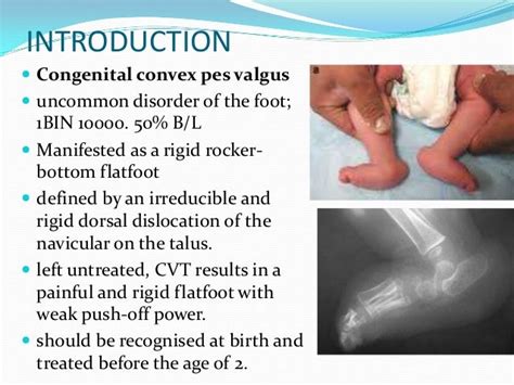 Congenital Vertical Talus Ug Lecture