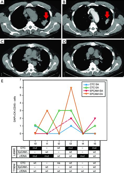 Imaging and liquid biopsy monitoring. (A) CT scan of the initial ...