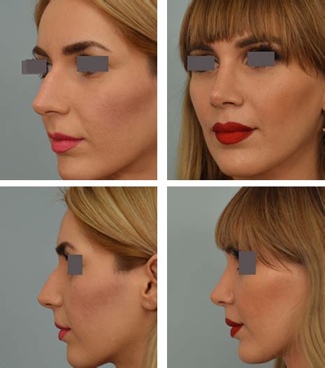 Rhinoplasty Los Angeles Best Nose Surgery Options Dr Grigoryants