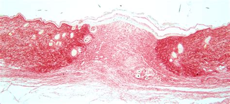 fibrosis edinburgh skin network institute  regeneration  repair