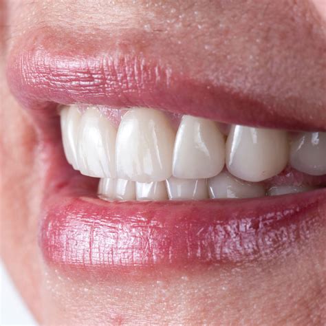 Dental Implants Gerrards Cross Face Teeth Smile