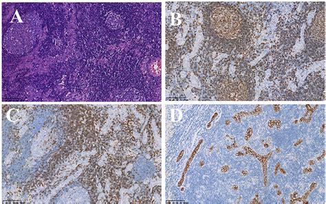 Frontiers Case Report Primary Lymphoepithelioma Like Intrahepatic