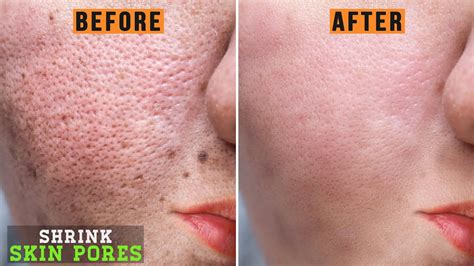 Get Rid Of Pores Scars And Shrink It Quick How To Close Open Pores Youtube