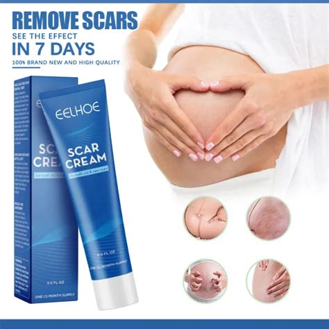 Scar Remover For Old Scar On Leg Bio Oil Stretch Mark Peklat Acne