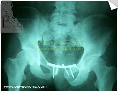 case 5 pelvic fracture – Professor Fouad Zamel Sadek