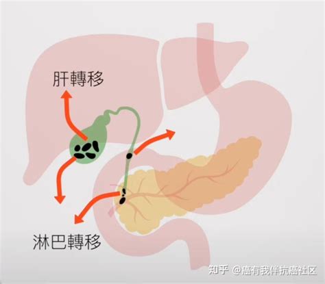 胆管癌患者术后该如何预防复发 知乎