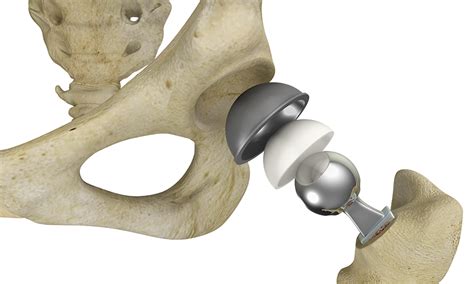 Complex Primary Hip Replacement Baltimore Md Hip Arthroplasty