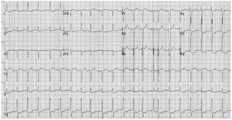 The Electrocardiography Shows A Sinus Tachycardia And ST Segment