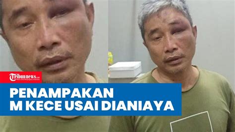 Penampakan M Kece Seusai Babak Belur Dianiaya Irjen Napoleon Ada 10