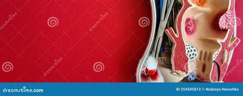 Colon Polyp Removal with Electrical Loop during Colonoscopy Stock Image ...