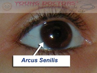 Photos For Arcus Senilis ~ YOUNG DOCTORS' RESEARCH FORUM