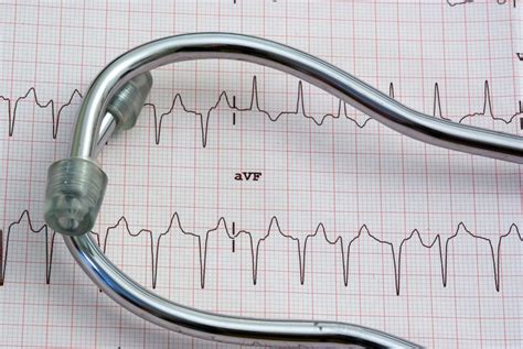 Electrocardiogram - Beverly Hills Cardiovascular