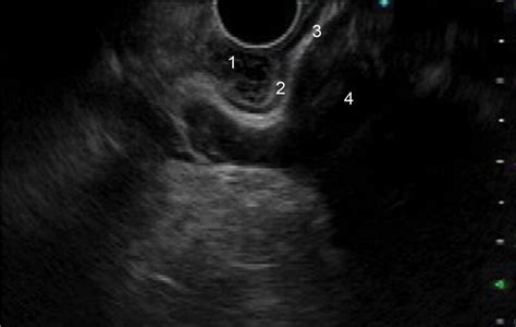 Endoscopic Ultrasound Eus Image Of Subepithelial Lesion Sel Arising Download Scientific