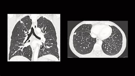 Metastatic Pulmonary Adenocarcinoma Complicated By Pe Siemens