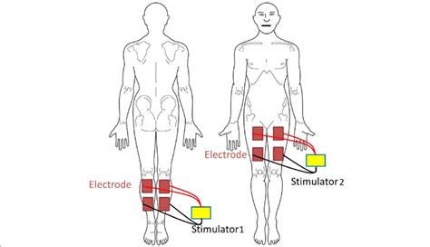 E Stim Electrode Placement