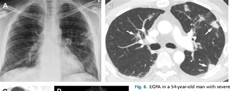 Figure From Imaging Of Eosinophilic Lung Diseases Semantic Scholar