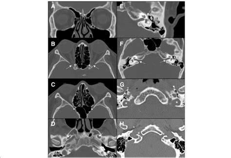 CT aspect of the most important foramina of the skull base. a... | Download Scientific Diagram