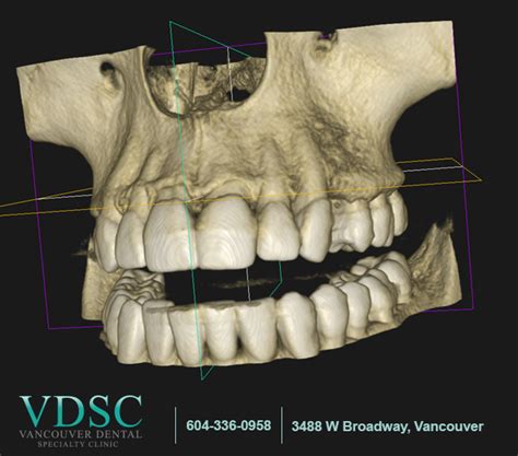 When Do You Need A Dental CBCT 3D Imaging VDSC