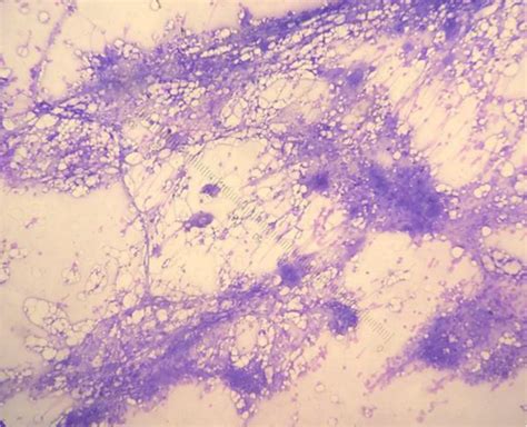 Bone Marrow Aspiration Demonstrating Increased Number Of Megakaryocytes