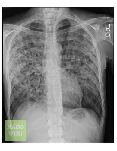 Lec 3 Pneumonia Flashcards Quizlet