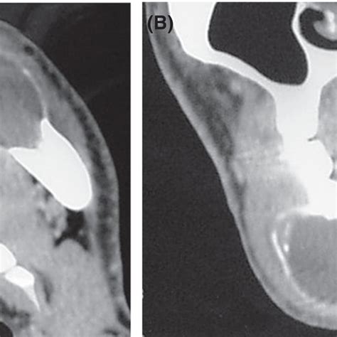 Inferior meatal antrostomy, after sac enucleation, while removing the... | Download Scientific ...