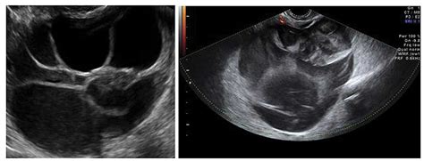 A Mucinous Cystadenoma With Variable Echogenicity Among The Cyst