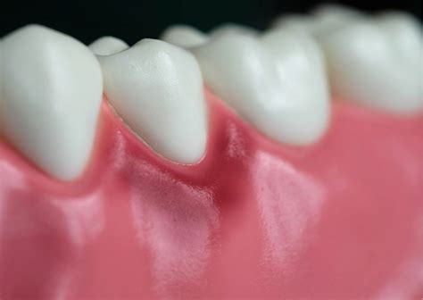 Dolor de encías causas y tratamiento Clínica Dental Everest